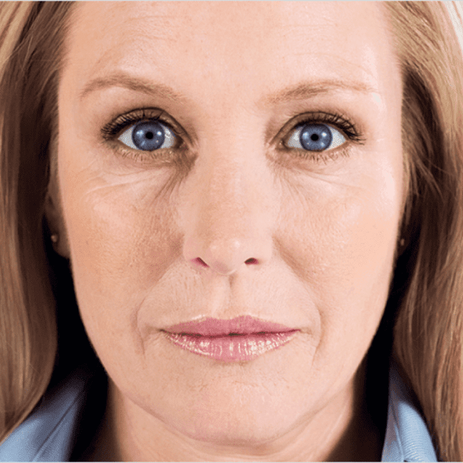 Sculptra Before and After - Case -1, Image 2 - Female, age 45 – 54 - Baltimore, MD - Elite Beauty Medical Spa