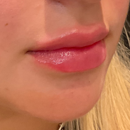 Fillers Before and After - Case 2, Image 4 - Female, age 25 – 34 - Baltimore, MD - Elite Beauty Medical Spa