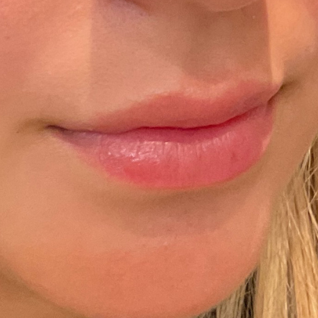 Fillers Before and After - Case 2, Image 3 - Female, age 25 – 34 - Baltimore, MD - Elite Beauty Medical Spa