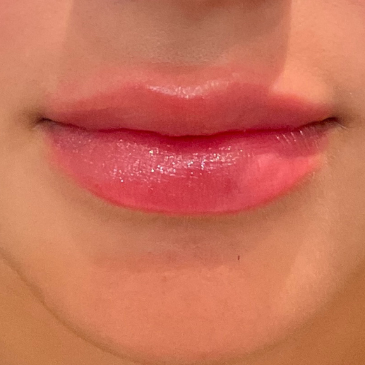 Fillers Before and After - Case 2, Image 2 - Female, age 25 – 34 - Baltimore, MD - Elite Beauty Medical Spa
