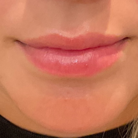 Fillers Before and After - Case 2, Image 1 - Female, age 25 – 34 - Baltimore, MD - Elite Beauty Medical Spa
